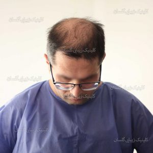ریزش مو