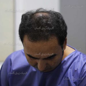 مزوتراپی