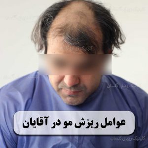عوامل ریزش مو در آقایان