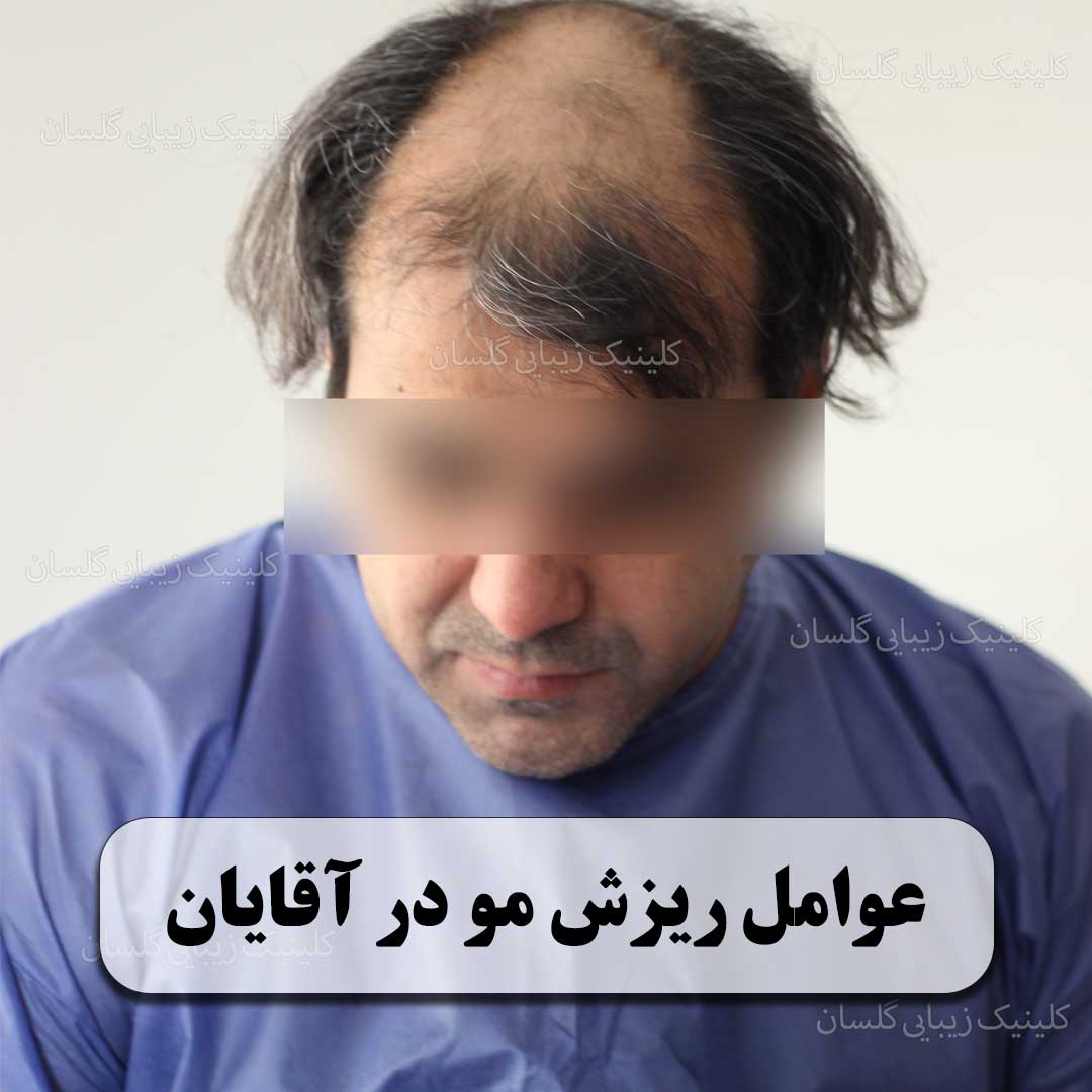 عوامل ریزش مو در آقایان