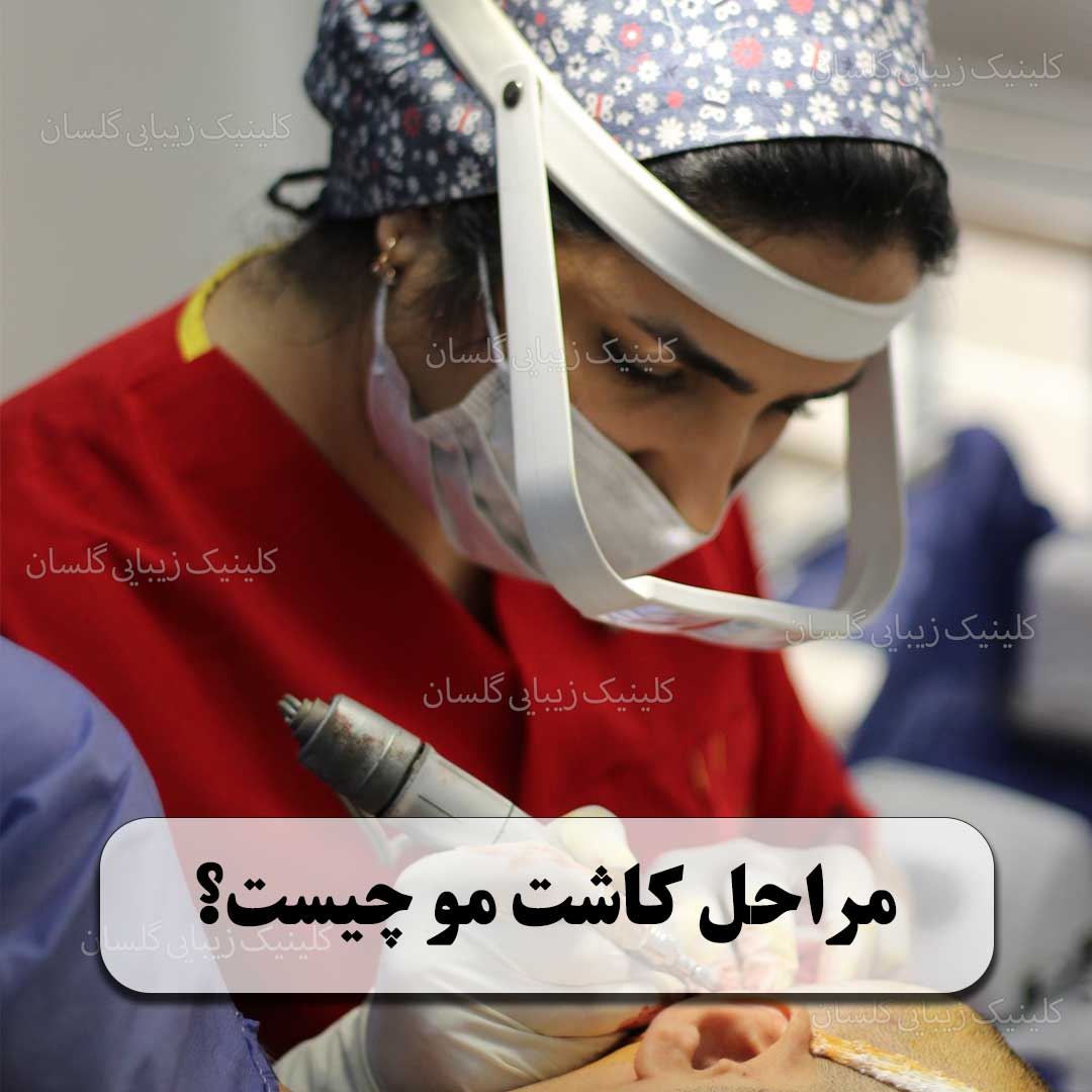 مراحل کاشت مو