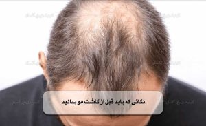 نکاتی که باید قبل از کاشت مو بدانید