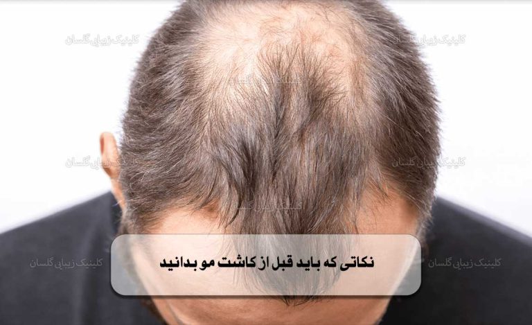 نکاتی که باید قبل از کاشت مو بدانید