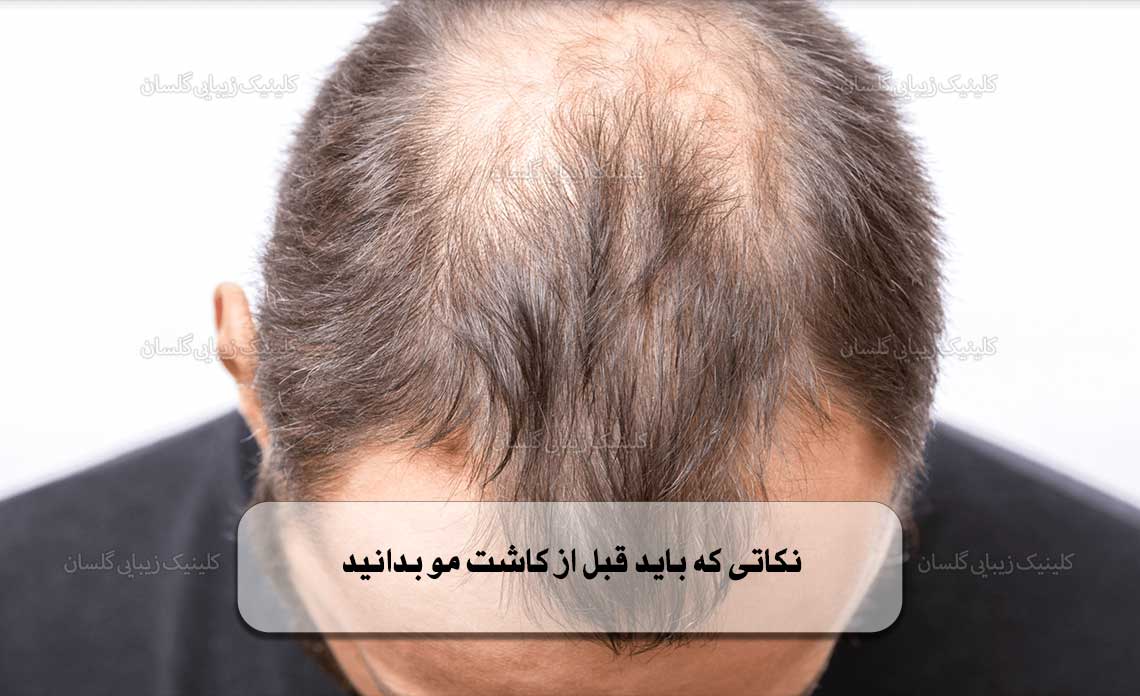 نکاتی که باید قبل از کاشت مو بدانید