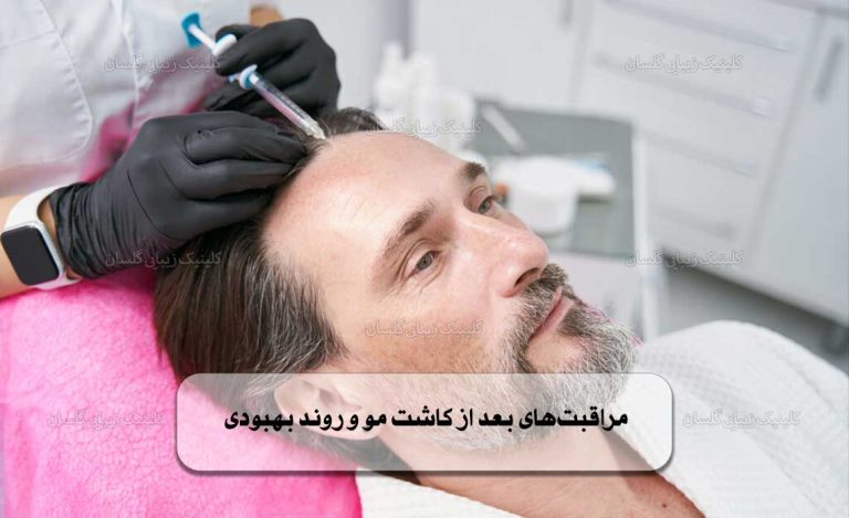 مراقبت‌های بعد از کاشت مو و روند بهبودی
