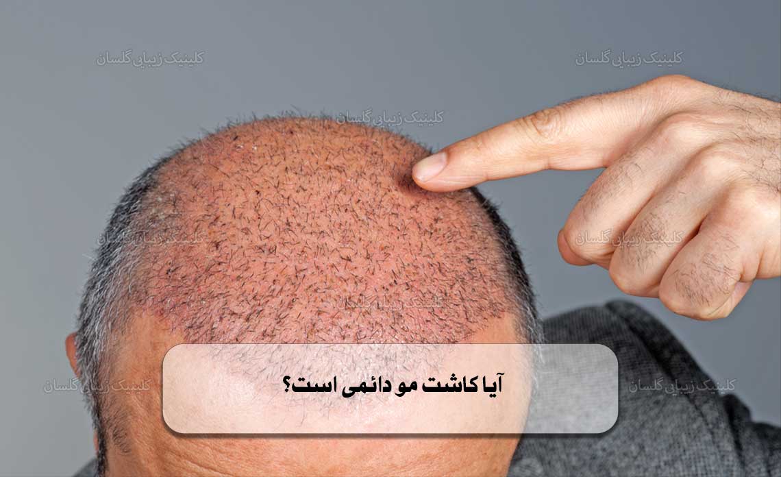 آیا کاشت مو دائمی است؟