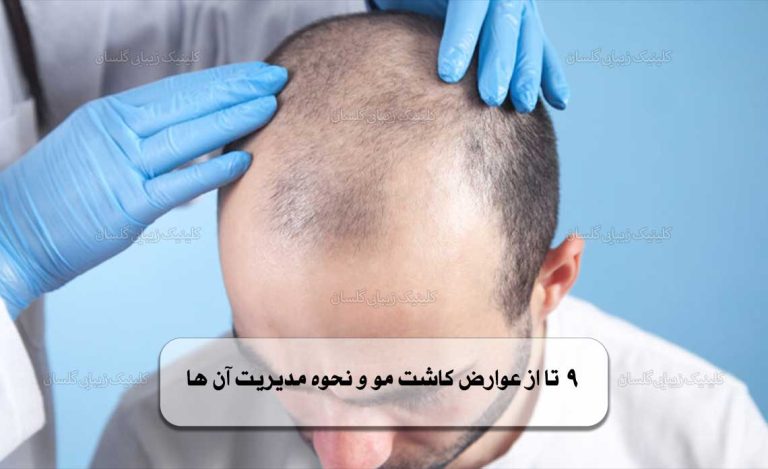9 تا از عوارض کاشت مو و نحوه مدیریت آن ها