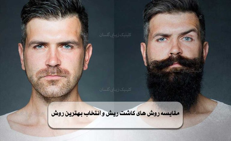 روش‌ های کاشت ریش