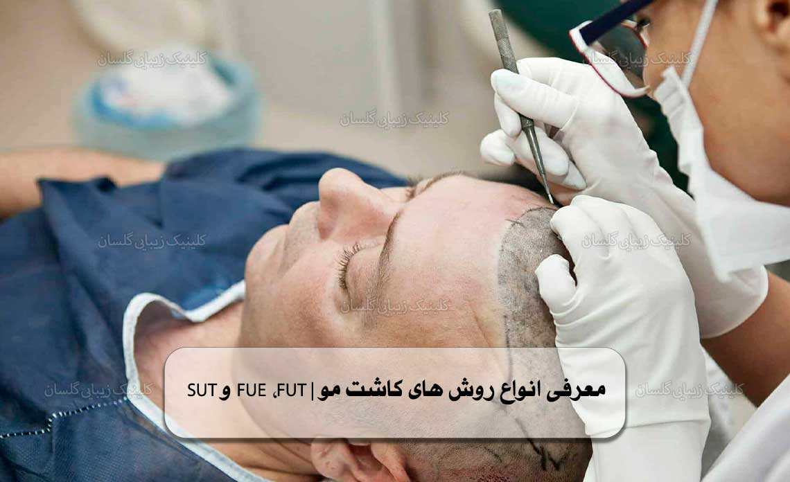 روش های کاشت مو