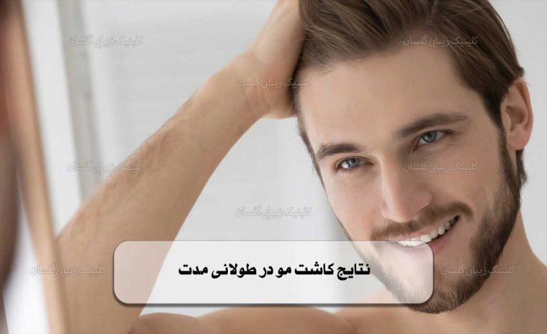 نتایج کاشت مو در طولانی‌ مدت