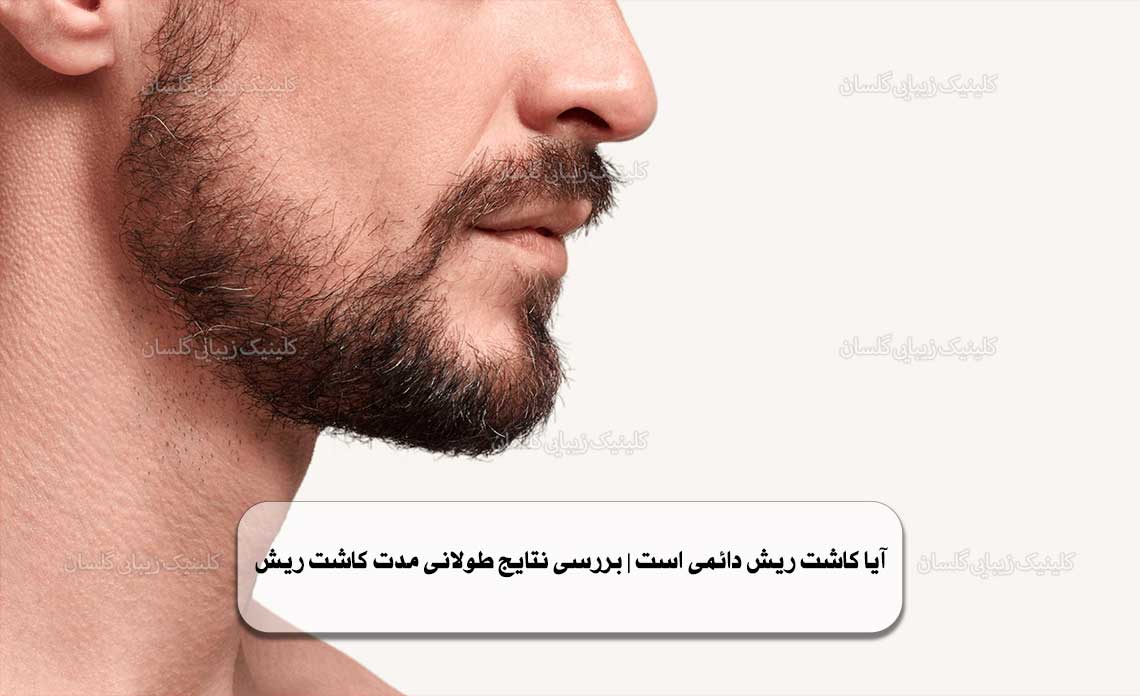 آیا کاشت ریش دائمی است