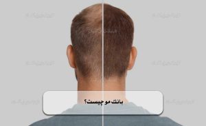 بانک مو چیست؟