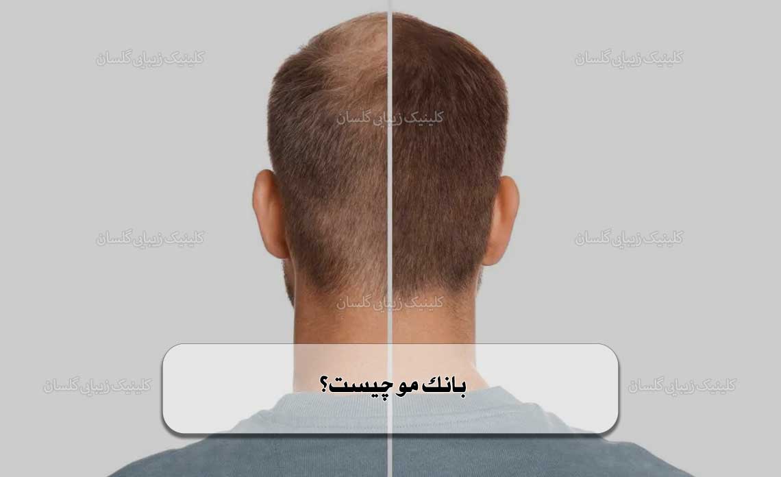 بانک مو چیست؟