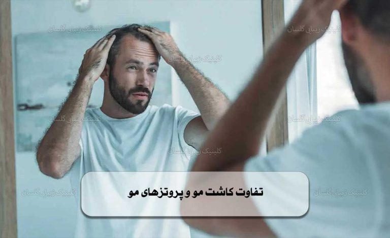 تفاوت کاشت مو و پروتزهای مو