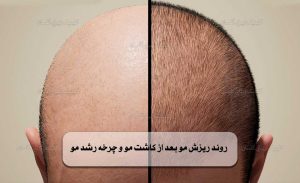 روند ریزش مو بعد از کاشت مو و چرخه رشد مو