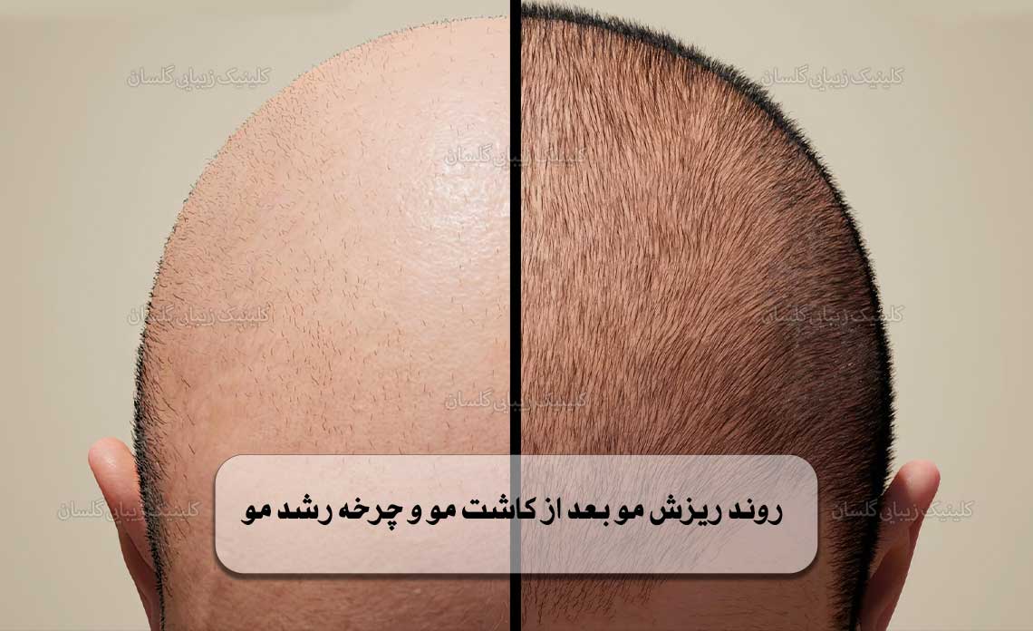 روند ریزش مو بعد از کاشت مو و چرخه رشد مو