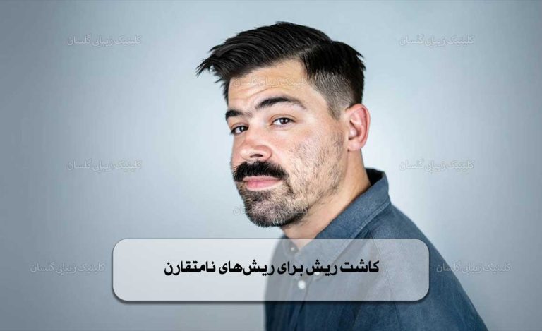 ریش‌های نامتقارن
