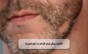 زخم صورت