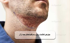 عوارض کاشت ریش و مراقبت‌های بعد از آن