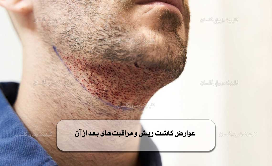 عوارض کاشت ریش و مراقبت‌های بعد از آن