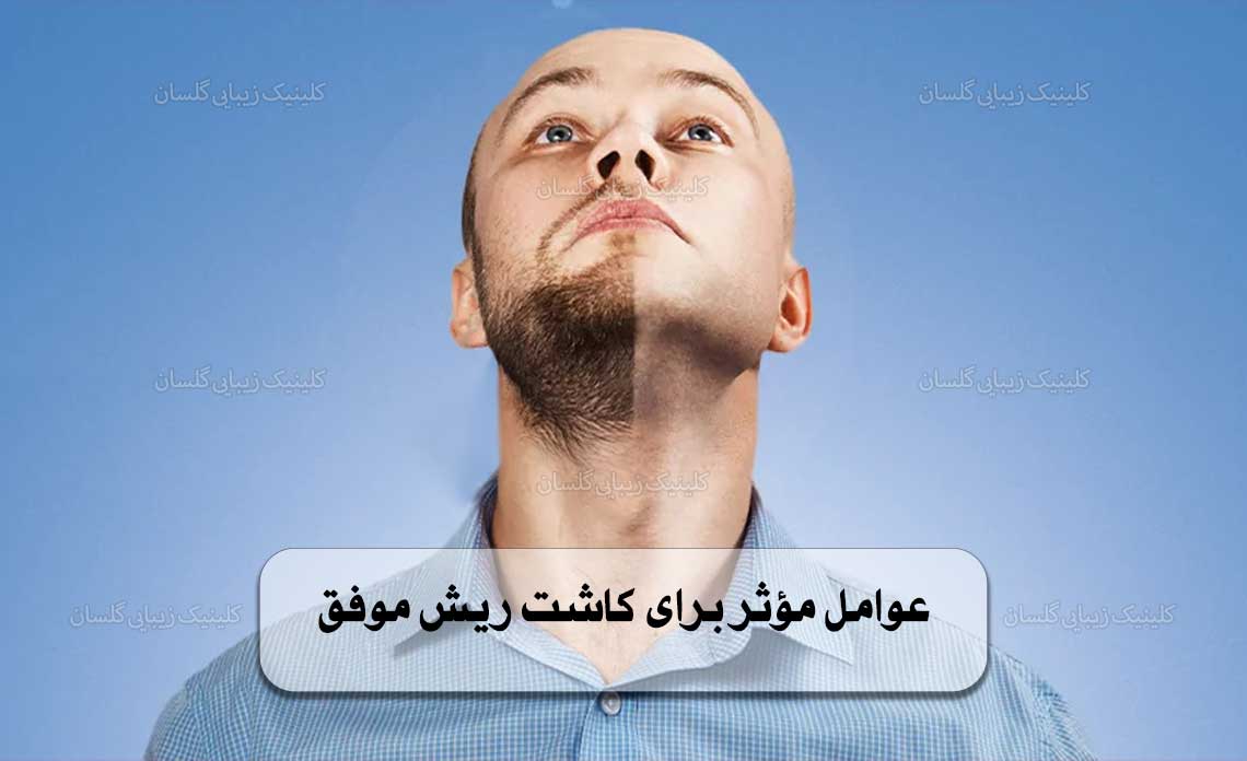 عوامل مؤثر برای کاشت ریش موفق
