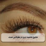 نتایج کاشت ابرو در طولانی مدت