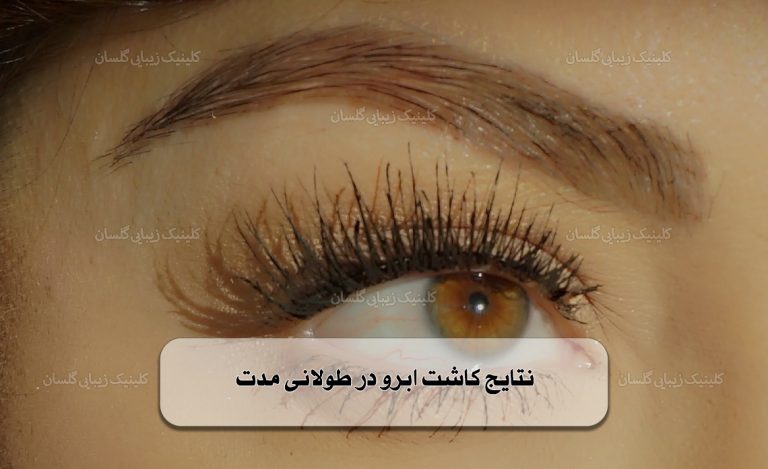 نتایج کاشت ابرو در طولانی مدت