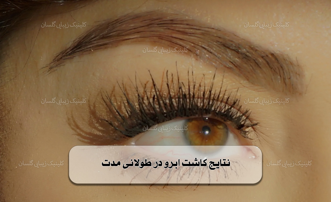 نتایج کاشت ابرو در طولانی مدت