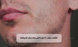 کاشت ریش راه‌ حل دائمی برای ریش کم پشت