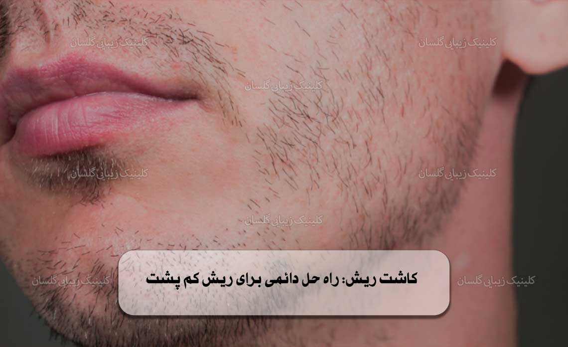 کاشت ریش راه‌ حل دائمی برای ریش کم پشت