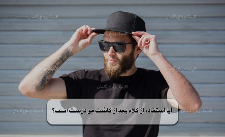 کلاه بعد از کاشت مو